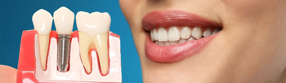 All-on-4 Implants® in Waterville ME