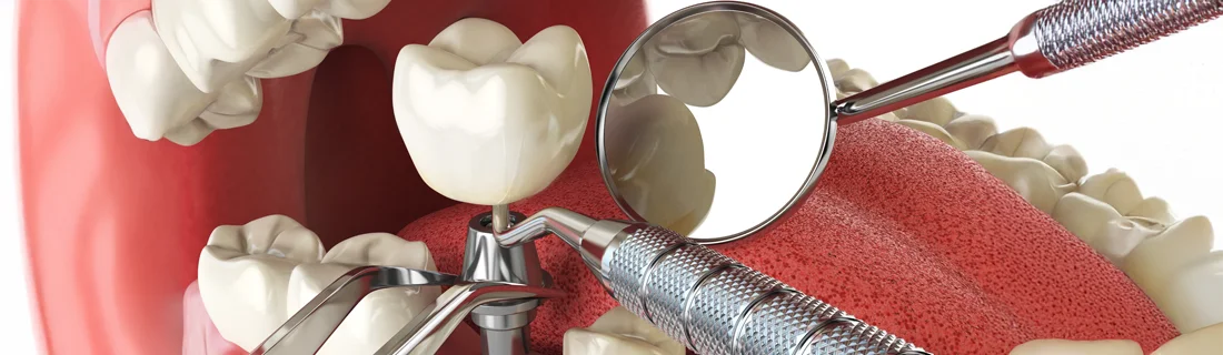 Dental Implant Repair in Waterville ME