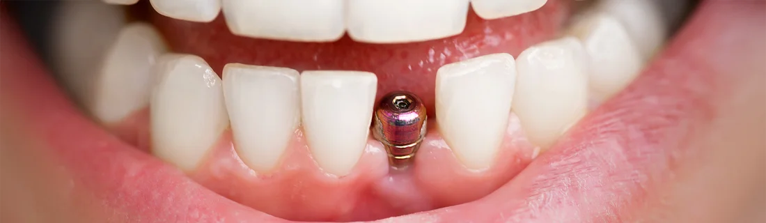 Missing Teeth in Waterville ME